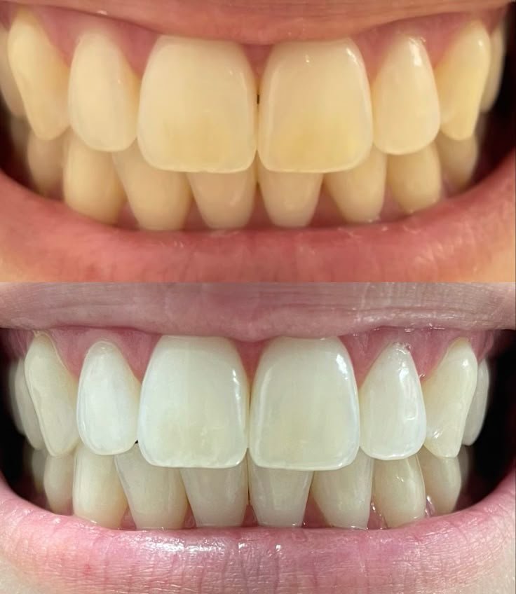 A bright, clean smile after polishing