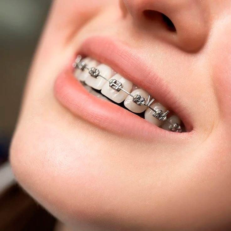 Diagram showing bite correction